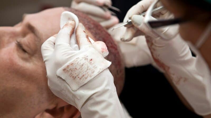 מחיר השתלת שיער