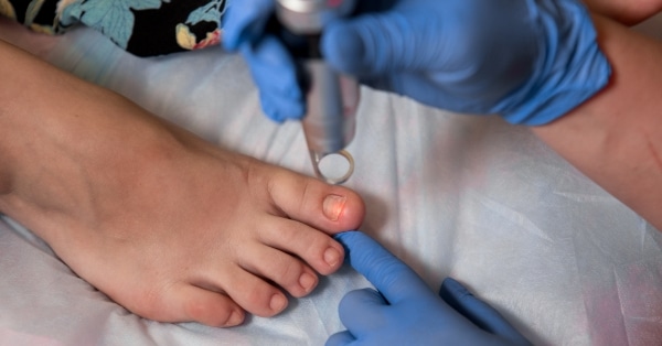 טיפול בפטרת הציפורניים