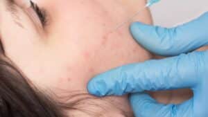 טיפול בפלזמה