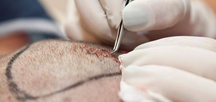 מחיר השתלת שיער